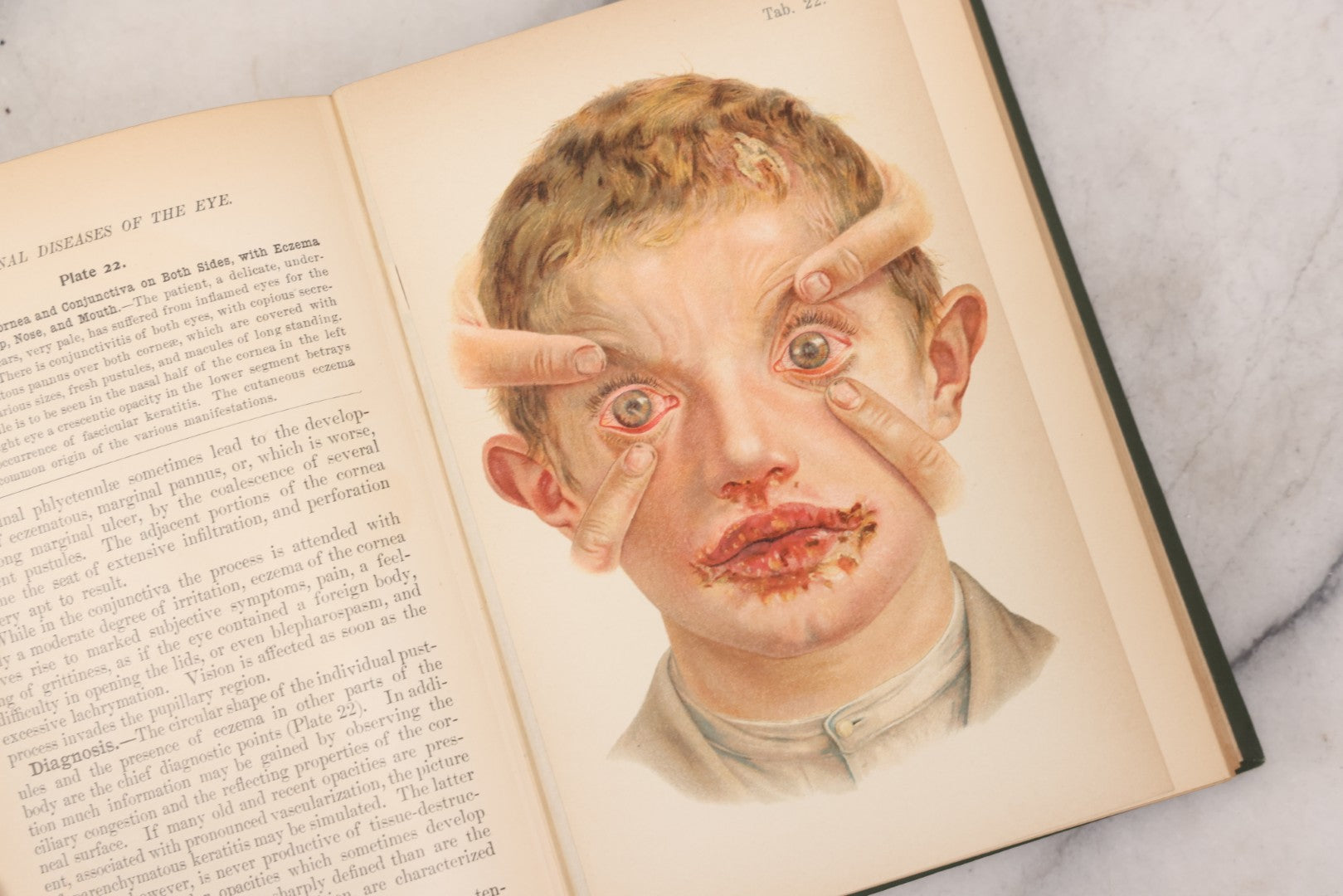 Lot 049 - "Atlas Of The External Diseases Of The Eye Including [...] Pathology And Treatment" Antique Medical Book By Prof. Dr. O. Haab, Translated From German, Illustrated With 76 Plates & 6 Engravings, Published By W.B. Saunders, Philadelphia, 1899