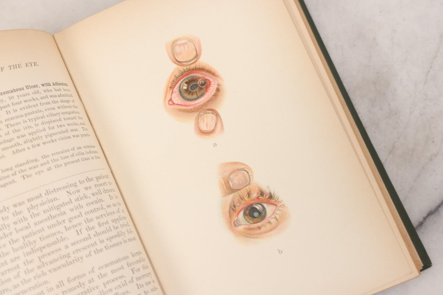 Lot 049 - "Atlas Of The External Diseases Of The Eye Including [...] Pathology And Treatment" Antique Medical Book By Prof. Dr. O. Haab, Translated From German, Illustrated With 76 Plates & 6 Engravings, Published By W.B. Saunders, Philadelphia, 1899