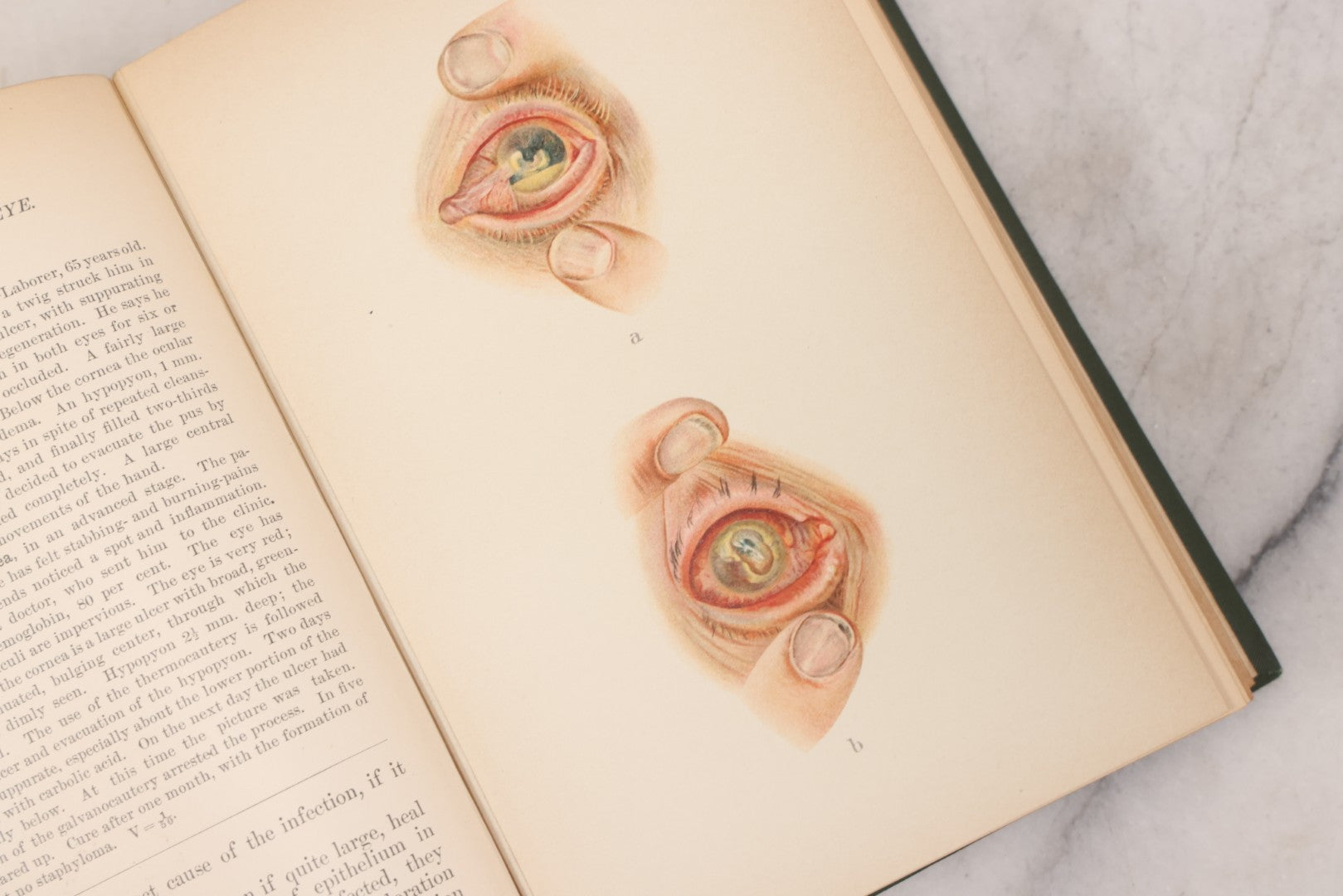 Lot 049 - "Atlas Of The External Diseases Of The Eye Including [...] Pathology And Treatment" Antique Medical Book By Prof. Dr. O. Haab, Translated From German, Illustrated With 76 Plates & 6 Engravings, Published By W.B. Saunders, Philadelphia, 1899