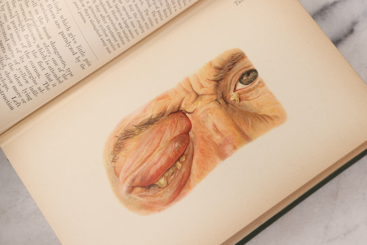 Lot 049 - "Atlas Of The External Diseases Of The Eye Including [...] Pathology And Treatment" Antique Medical Book By Prof. Dr. O. Haab, Translated From German, Illustrated With 76 Plates & 6 Engravings, Published By W.B. Saunders, Philadelphia, 1899