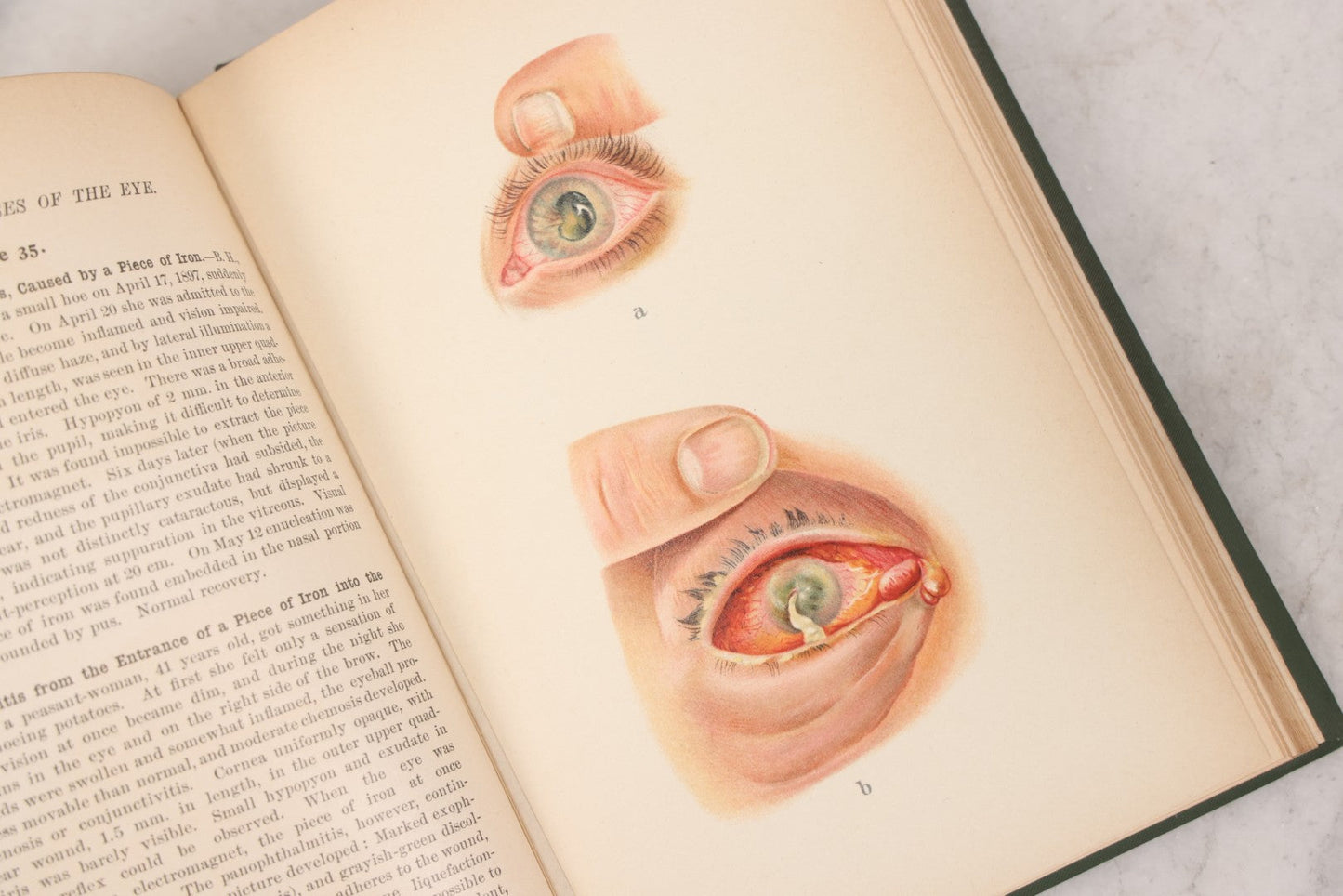 Lot 049 - "Atlas Of The External Diseases Of The Eye Including [...] Pathology And Treatment" Antique Medical Book By Prof. Dr. O. Haab, Translated From German, Illustrated With 76 Plates & 6 Engravings, Published By W.B. Saunders, Philadelphia, 1899