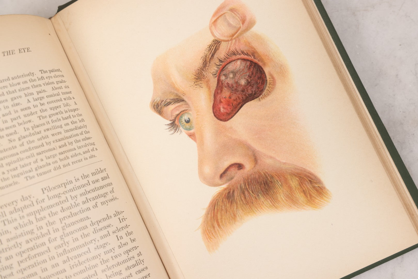 Lot 049 - "Atlas Of The External Diseases Of The Eye Including [...] Pathology And Treatment" Antique Medical Book By Prof. Dr. O. Haab, Translated From German, Illustrated With 76 Plates & 6 Engravings, Published By W.B. Saunders, Philadelphia, 1899