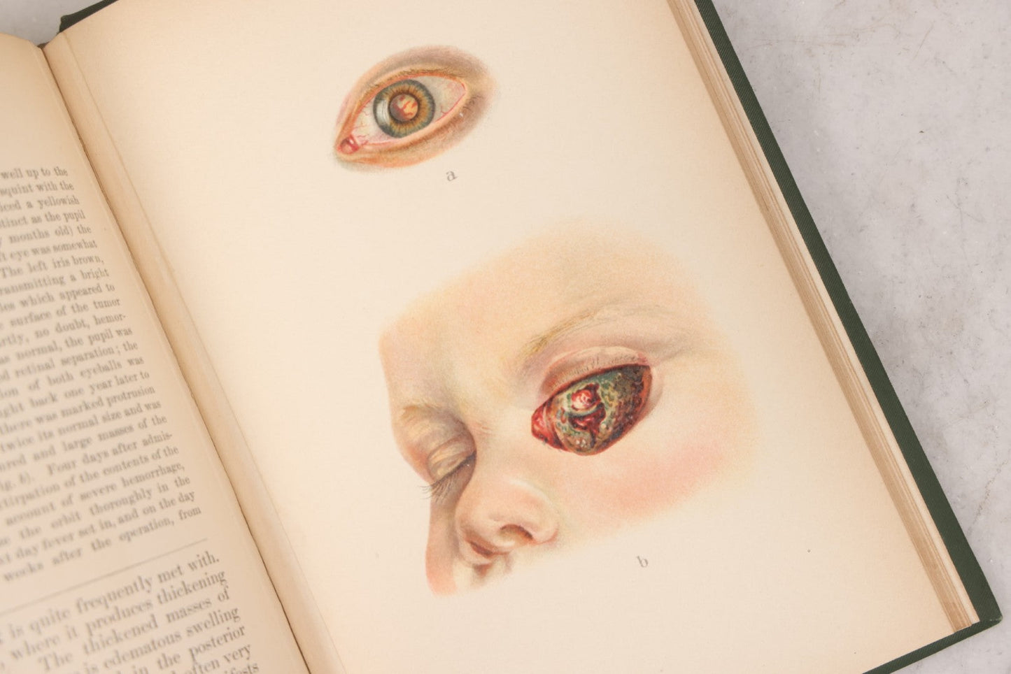 Lot 049 - "Atlas Of The External Diseases Of The Eye Including [...] Pathology And Treatment" Antique Medical Book By Prof. Dr. O. Haab, Translated From German, Illustrated With 76 Plates & 6 Engravings, Published By W.B. Saunders, Philadelphia, 1899