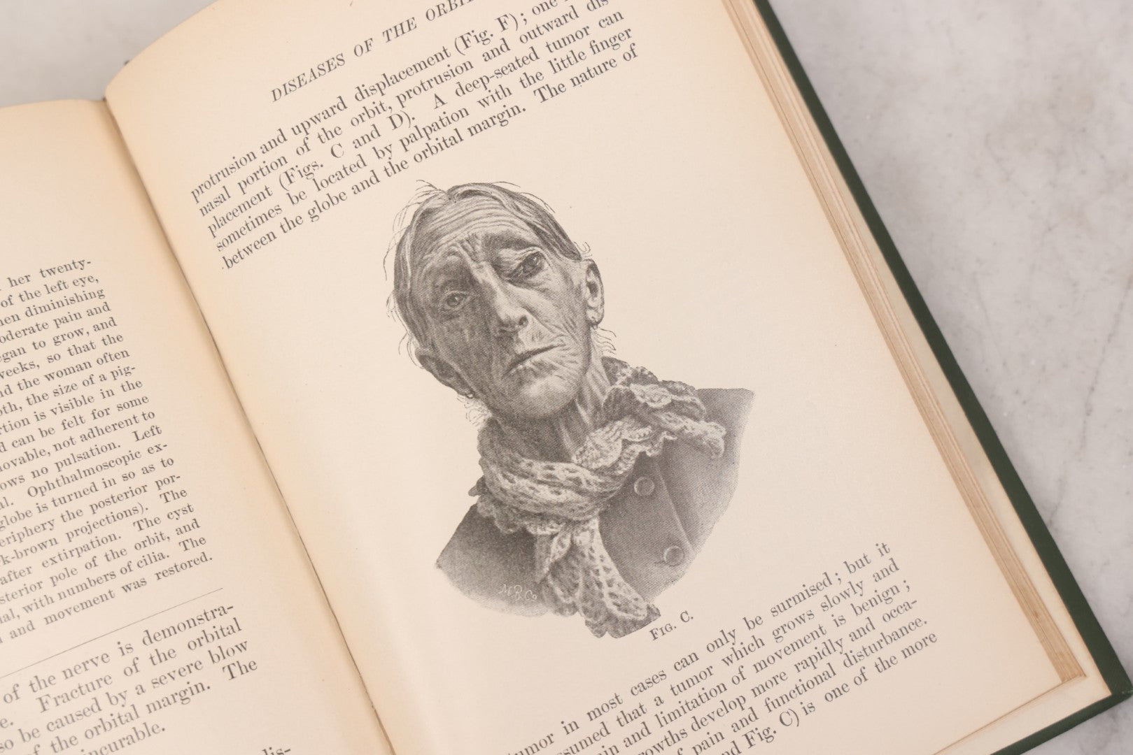 Lot 049 - "Atlas Of The External Diseases Of The Eye Including [...] Pathology And Treatment" Antique Medical Book By Prof. Dr. O. Haab, Translated From German, Illustrated With 76 Plates & 6 Engravings, Published By W.B. Saunders, Philadelphia, 1899