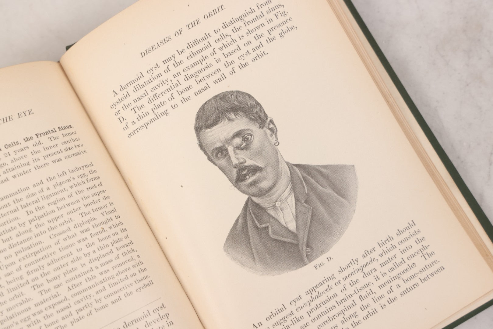 Lot 049 - "Atlas Of The External Diseases Of The Eye Including [...] Pathology And Treatment" Antique Medical Book By Prof. Dr. O. Haab, Translated From German, Illustrated With 76 Plates & 6 Engravings, Published By W.B. Saunders, Philadelphia, 1899