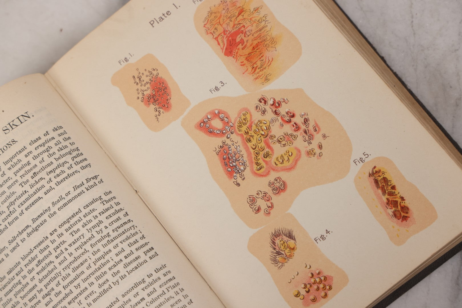 Lot 051 - "The People's Common Sense Medical Adviser In Plain English, Or, Medicine Simplified" Antique Illustrated Medical Book By R.V. Pierce, M.D., Seventy-First Edition, Buffalo, New York, 1895