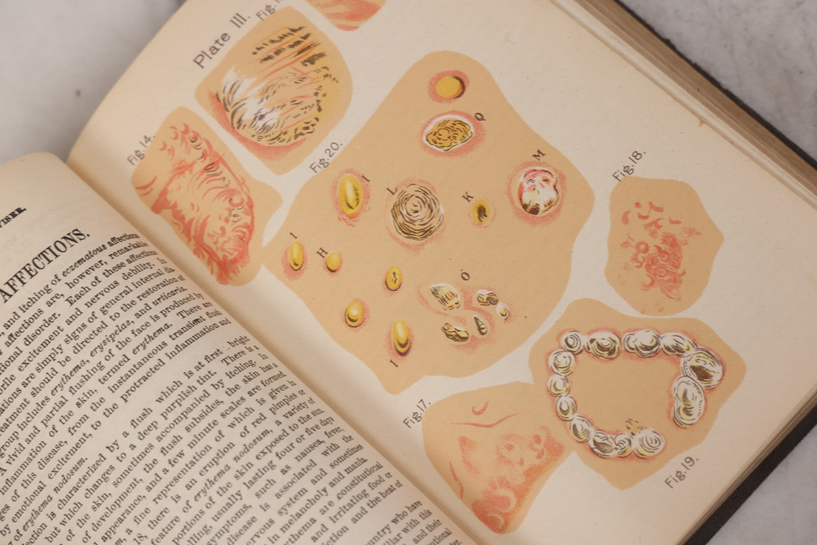 Lot 051 - "The People's Common Sense Medical Adviser In Plain English, Or, Medicine Simplified" Antique Illustrated Medical Book By R.V. Pierce, M.D., Seventy-First Edition, Buffalo, New York, 1895