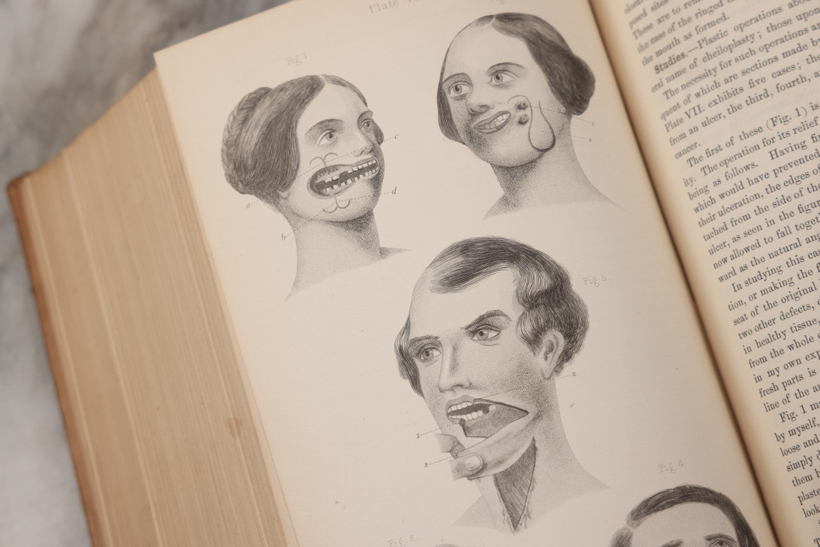 Lot 055 - "A System Of Oral Surgery: Diseases And Surgery Of The Mouth, Jaws, And Associated Parts" Antique Book By James E. Garretson, M.D., Illustrated With Steel Plates And Wood Cuts, 3rd Edition, Published By J.B. Lippincott & Co., Philadelphia, 1881
