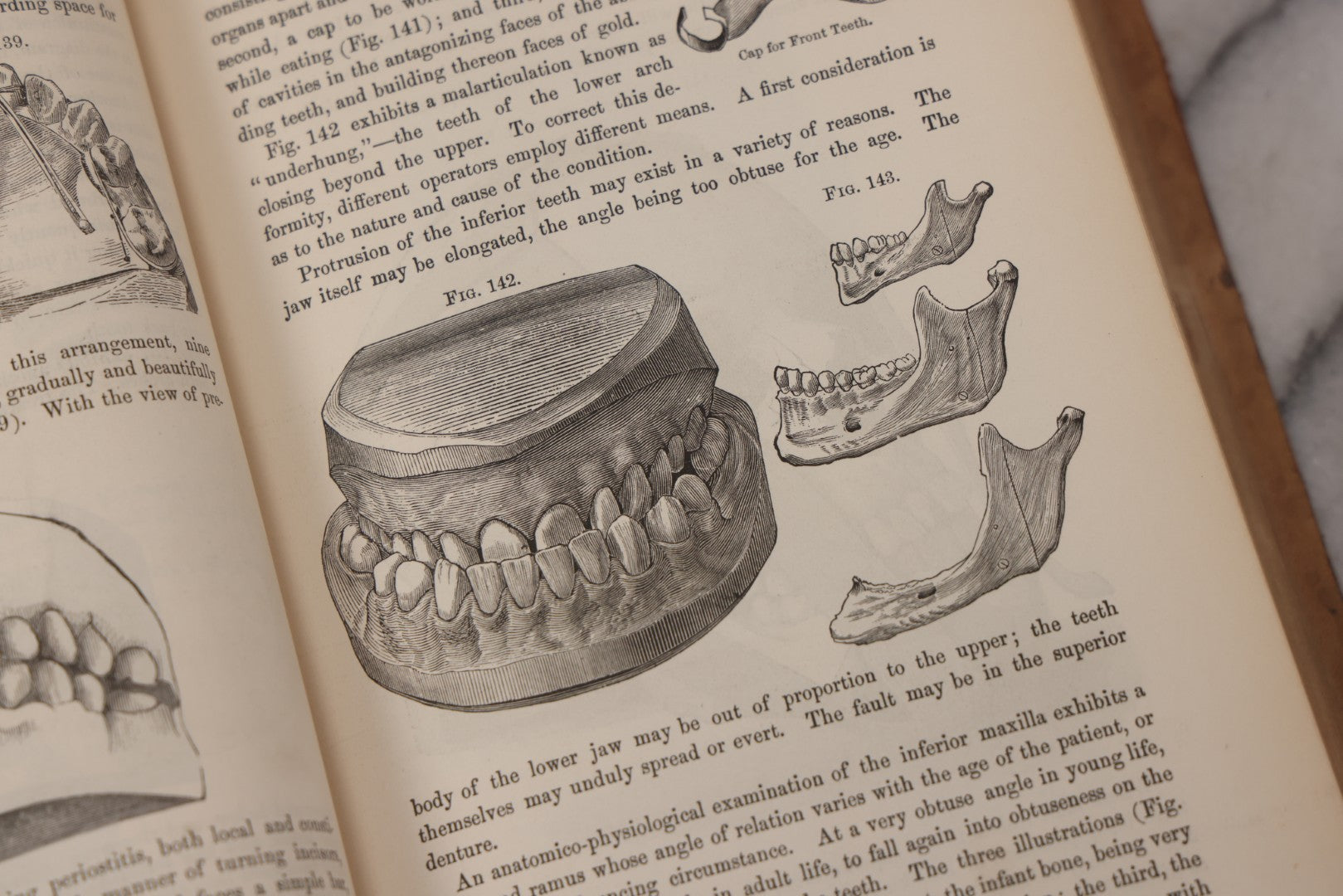 Lot 055 - "A System Of Oral Surgery: Diseases And Surgery Of The Mouth, Jaws, And Associated Parts" Antique Book By James E. Garretson, M.D., Illustrated With Steel Plates And Wood Cuts, 3rd Edition, Published By J.B. Lippincott & Co., Philadelphia, 1881