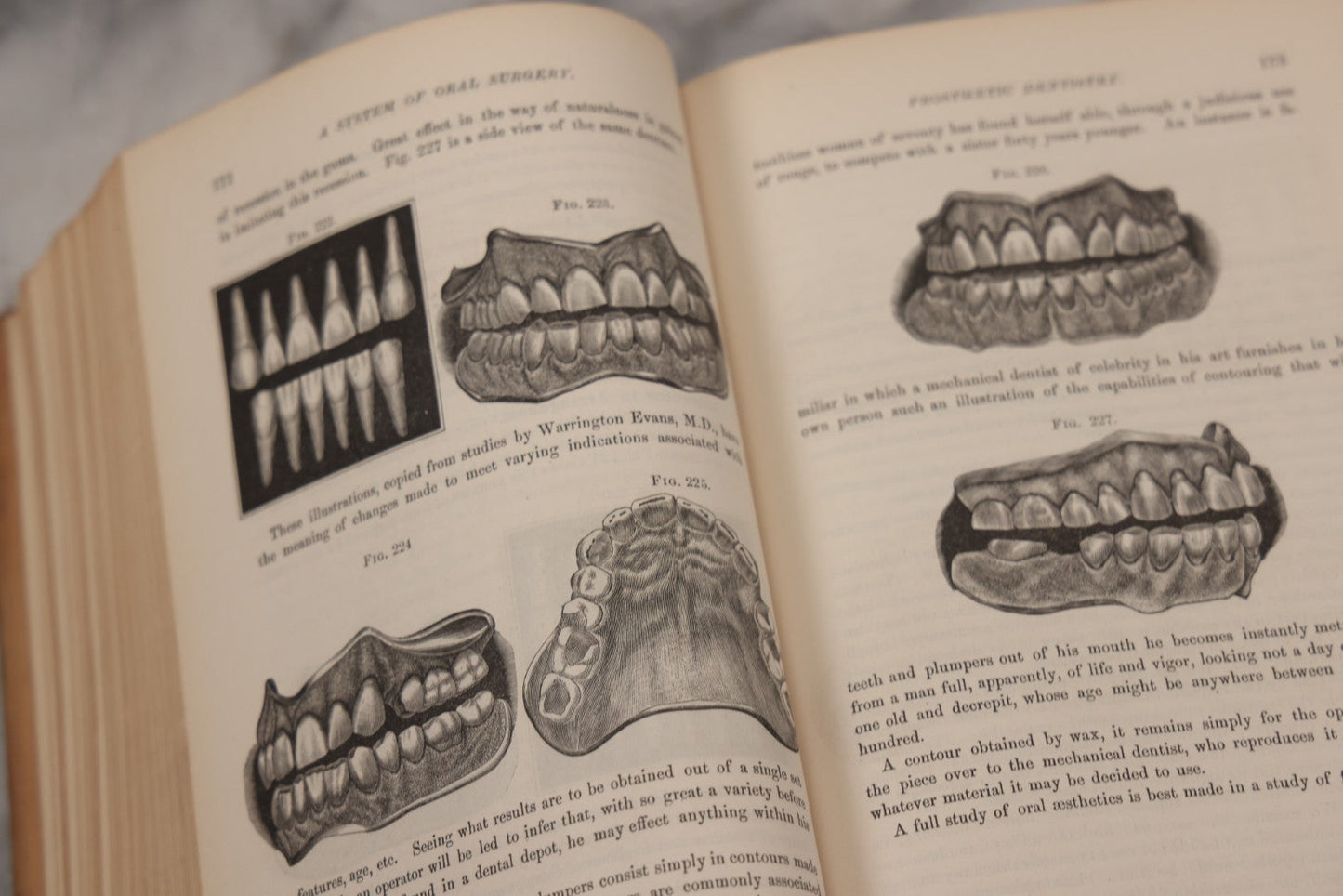 Lot 055 - "A System Of Oral Surgery: Diseases And Surgery Of The Mouth, Jaws, And Associated Parts" Antique Book By James E. Garretson, M.D., Illustrated With Steel Plates And Wood Cuts, 3rd Edition, Published By J.B. Lippincott & Co., Philadelphia, 1881