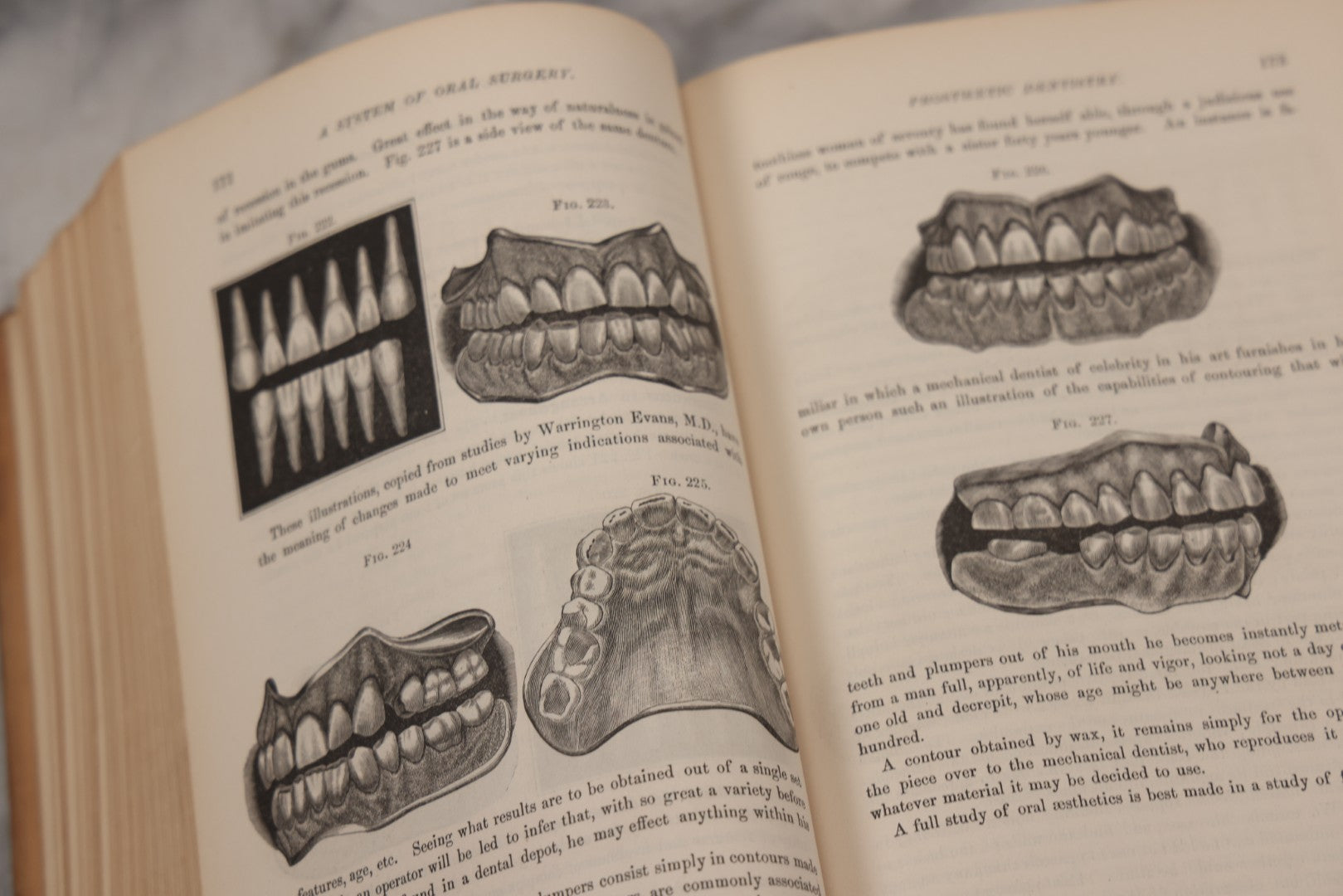 Lot 055 - "A System Of Oral Surgery: Diseases And Surgery Of The Mouth, Jaws, And Associated Parts" Antique Book By James E. Garretson, M.D., Illustrated With Steel Plates And Wood Cuts, 3rd Edition, Published By J.B. Lippincott & Co., Philadelphia, 1881