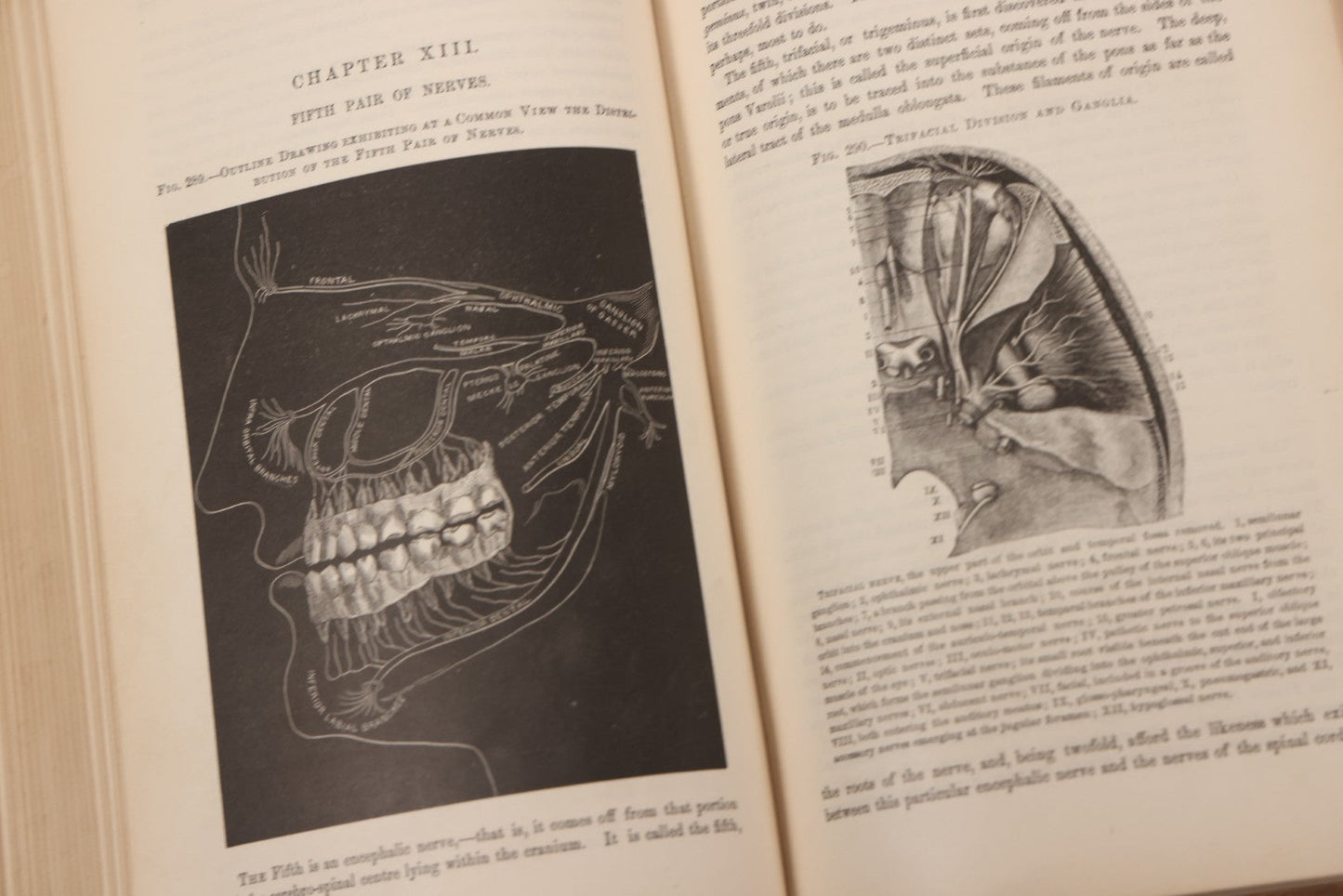 Lot 055 - "A System Of Oral Surgery: Diseases And Surgery Of The Mouth, Jaws, And Associated Parts" Antique Book By James E. Garretson, M.D., Illustrated With Steel Plates And Wood Cuts, 3rd Edition, Published By J.B. Lippincott & Co., Philadelphia, 1881