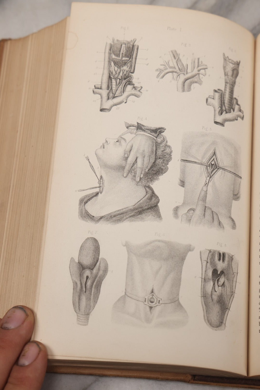 Lot 055 - "A System Of Oral Surgery: Diseases And Surgery Of The Mouth, Jaws, And Associated Parts" Antique Book By James E. Garretson, M.D., Illustrated With Steel Plates And Wood Cuts, 3rd Edition, Published By J.B. Lippincott & Co., Philadelphia, 1881