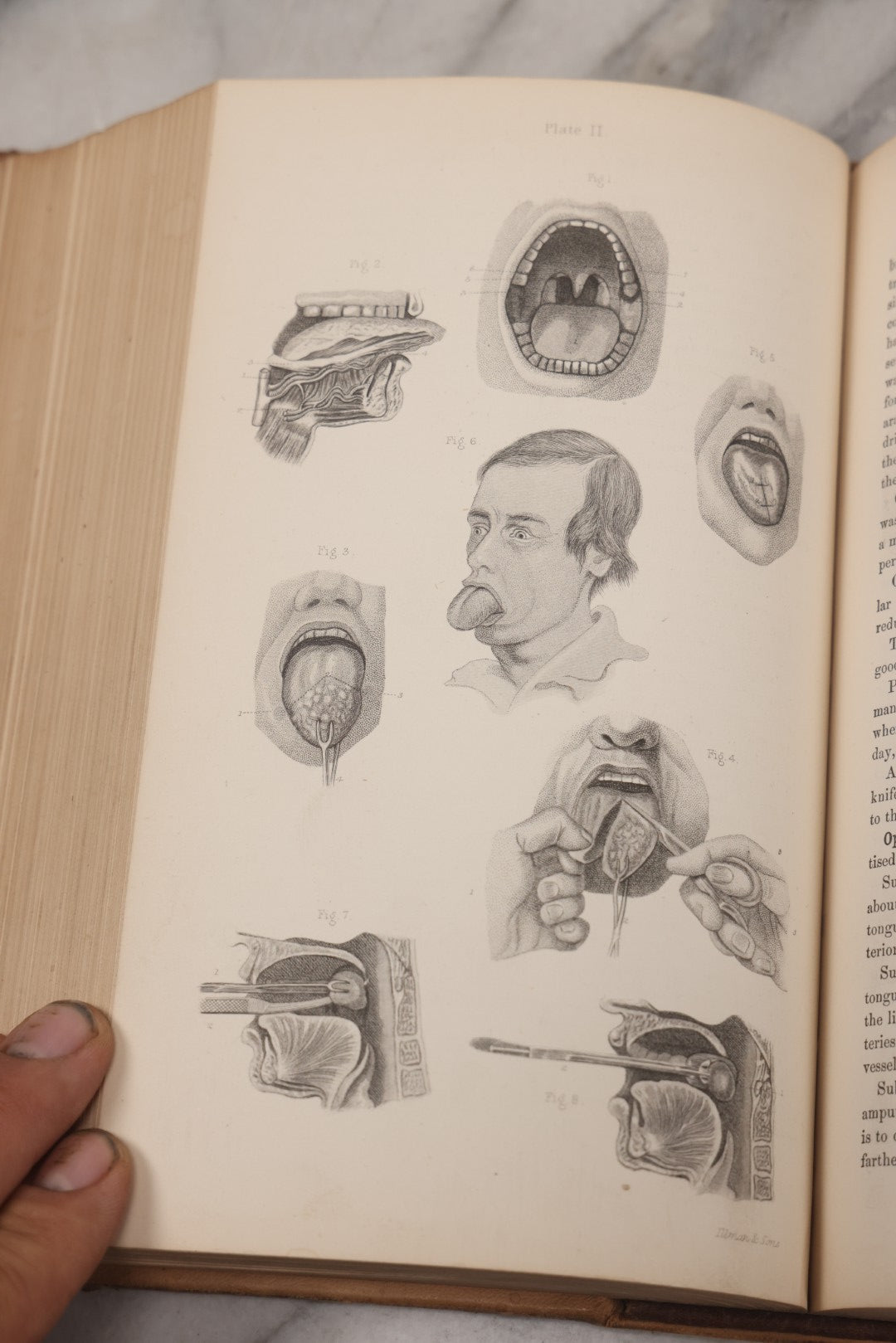 Lot 055 - "A System Of Oral Surgery: Diseases And Surgery Of The Mouth, Jaws, And Associated Parts" Antique Book By James E. Garretson, M.D., Illustrated With Steel Plates And Wood Cuts, 3rd Edition, Published By J.B. Lippincott & Co., Philadelphia, 1881