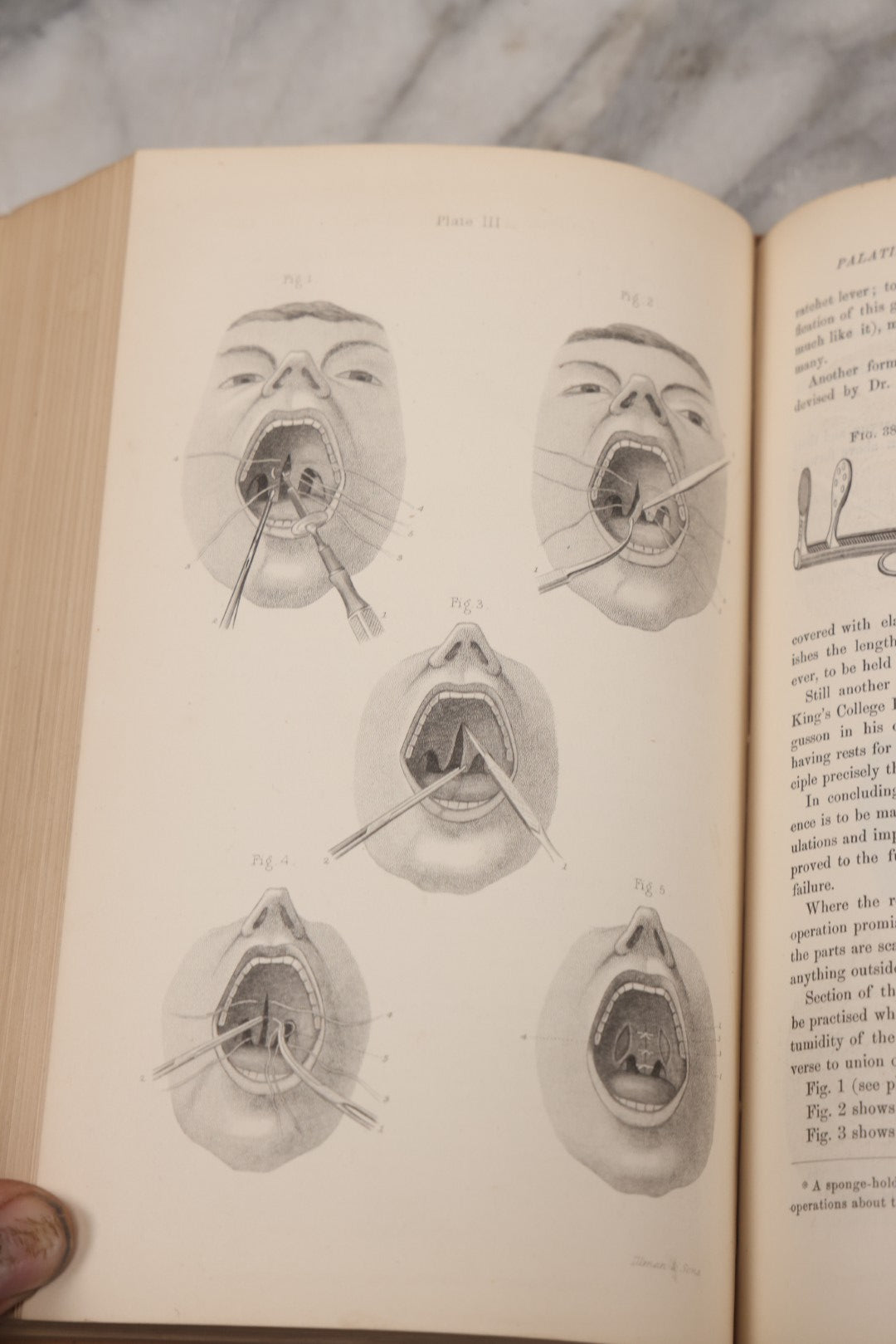 Lot 055 - "A System Of Oral Surgery: Diseases And Surgery Of The Mouth, Jaws, And Associated Parts" Antique Book By James E. Garretson, M.D., Illustrated With Steel Plates And Wood Cuts, 3rd Edition, Published By J.B. Lippincott & Co., Philadelphia, 1881