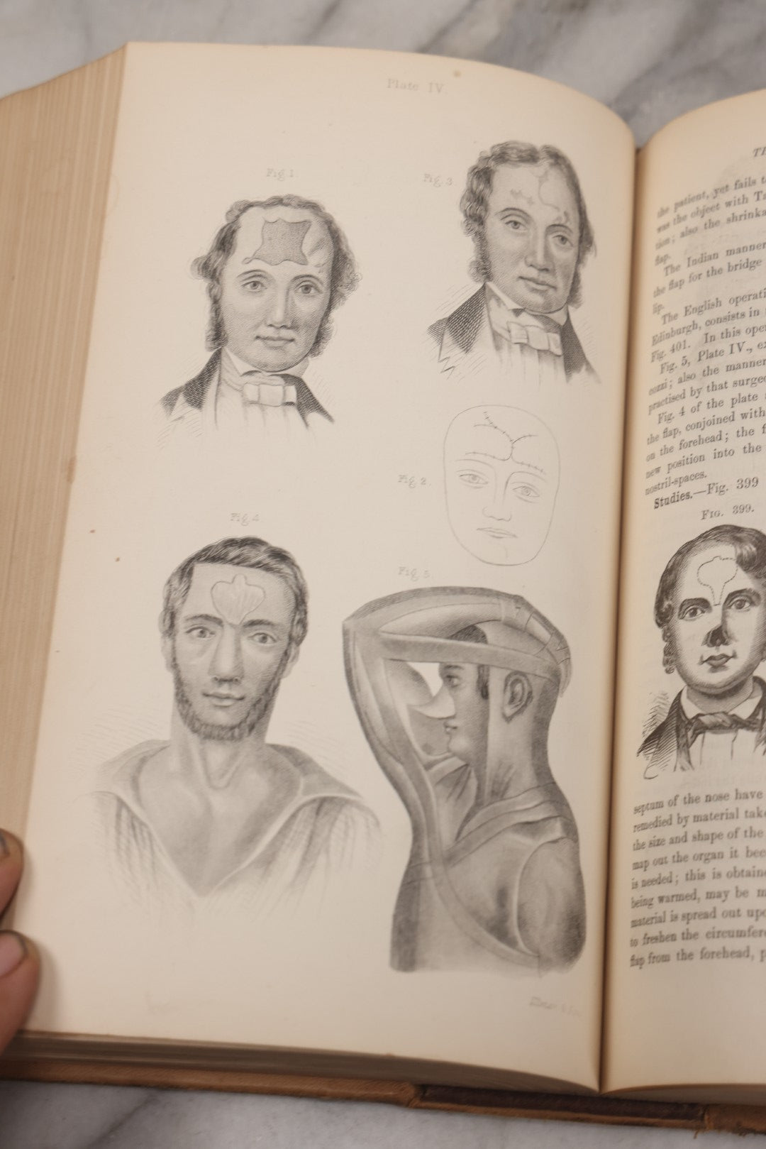 Lot 055 - "A System Of Oral Surgery: Diseases And Surgery Of The Mouth, Jaws, And Associated Parts" Antique Book By James E. Garretson, M.D., Illustrated With Steel Plates And Wood Cuts, 3rd Edition, Published By J.B. Lippincott & Co., Philadelphia, 1881