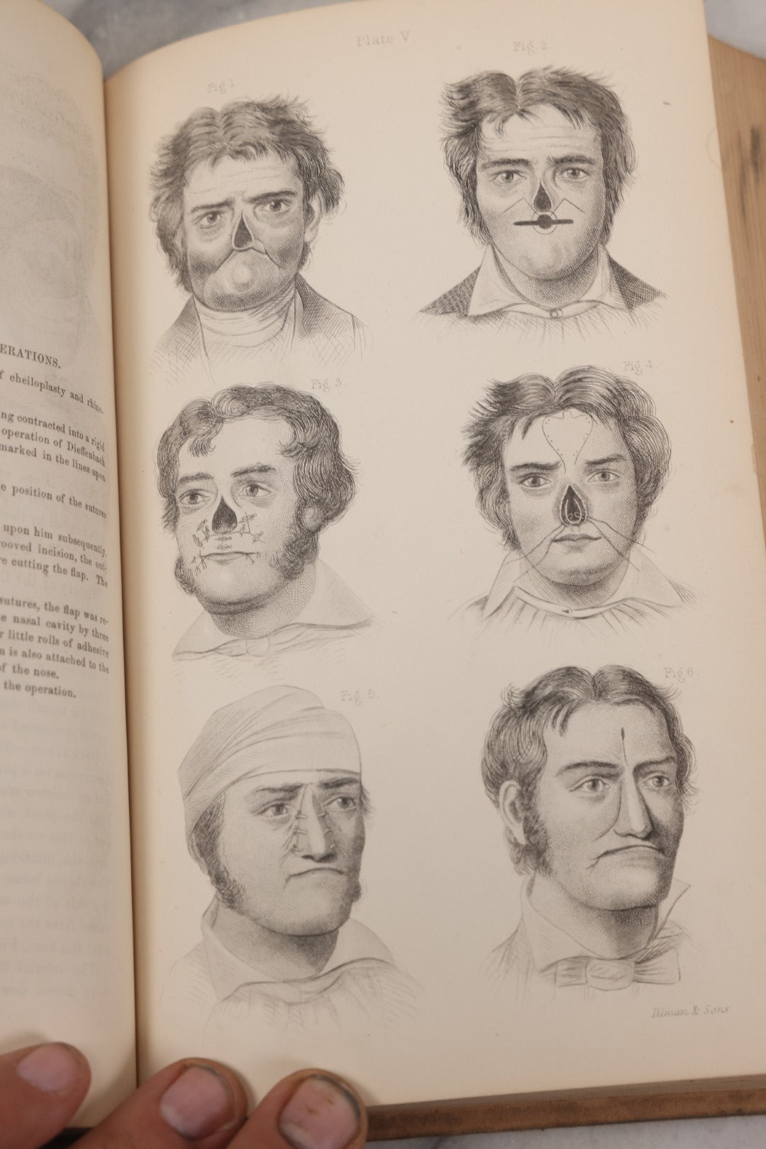 Lot 055 - "A System Of Oral Surgery: Diseases And Surgery Of The Mouth, Jaws, And Associated Parts" Antique Book By James E. Garretson, M.D., Illustrated With Steel Plates And Wood Cuts, 3rd Edition, Published By J.B. Lippincott & Co., Philadelphia, 1881