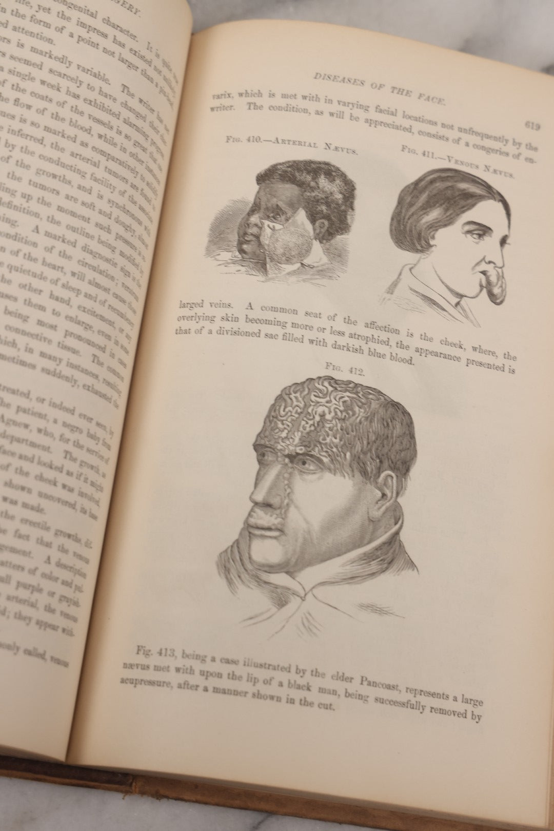 Lot 055 - "A System Of Oral Surgery: Diseases And Surgery Of The Mouth, Jaws, And Associated Parts" Antique Book By James E. Garretson, M.D., Illustrated With Steel Plates And Wood Cuts, 3rd Edition, Published By J.B. Lippincott & Co., Philadelphia, 1881