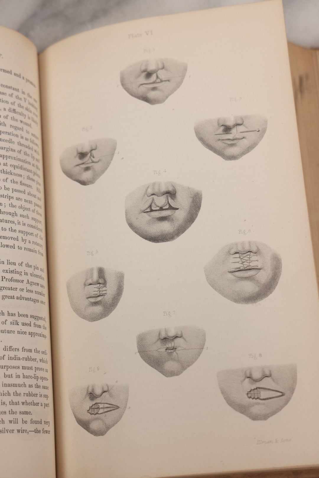 Lot 055 - "A System Of Oral Surgery: Diseases And Surgery Of The Mouth, Jaws, And Associated Parts" Antique Book By James E. Garretson, M.D., Illustrated With Steel Plates And Wood Cuts, 3rd Edition, Published By J.B. Lippincott & Co., Philadelphia, 1881