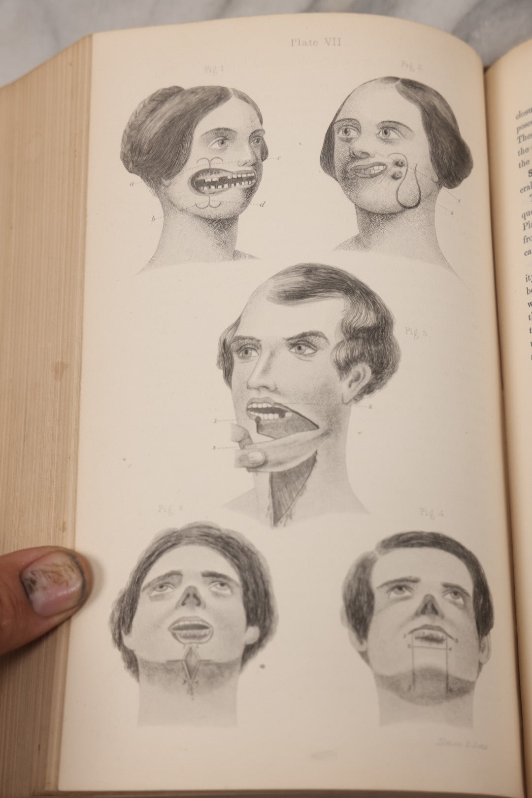 Lot 055 - "A System Of Oral Surgery: Diseases And Surgery Of The Mouth, Jaws, And Associated Parts" Antique Book By James E. Garretson, M.D., Illustrated With Steel Plates And Wood Cuts, 3rd Edition, Published By J.B. Lippincott & Co., Philadelphia, 1881