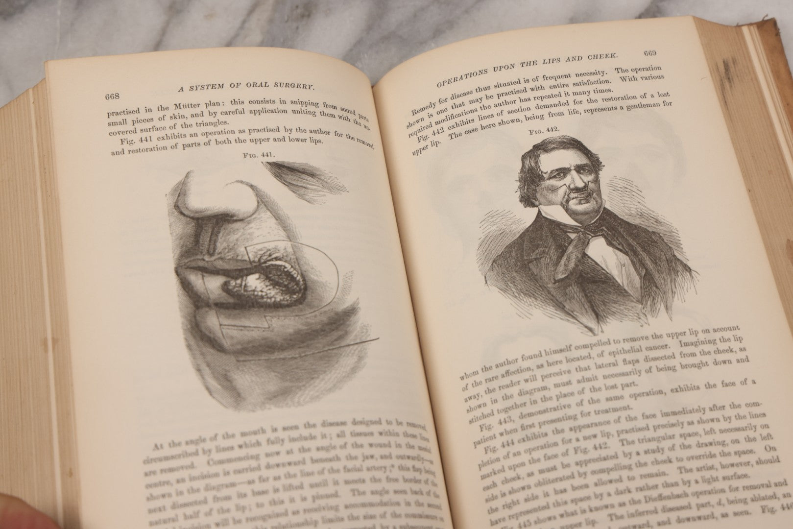 Lot 055 - "A System Of Oral Surgery: Diseases And Surgery Of The Mouth, Jaws, And Associated Parts" Antique Book By James E. Garretson, M.D., Illustrated With Steel Plates And Wood Cuts, 3rd Edition, Published By J.B. Lippincott & Co., Philadelphia, 1881