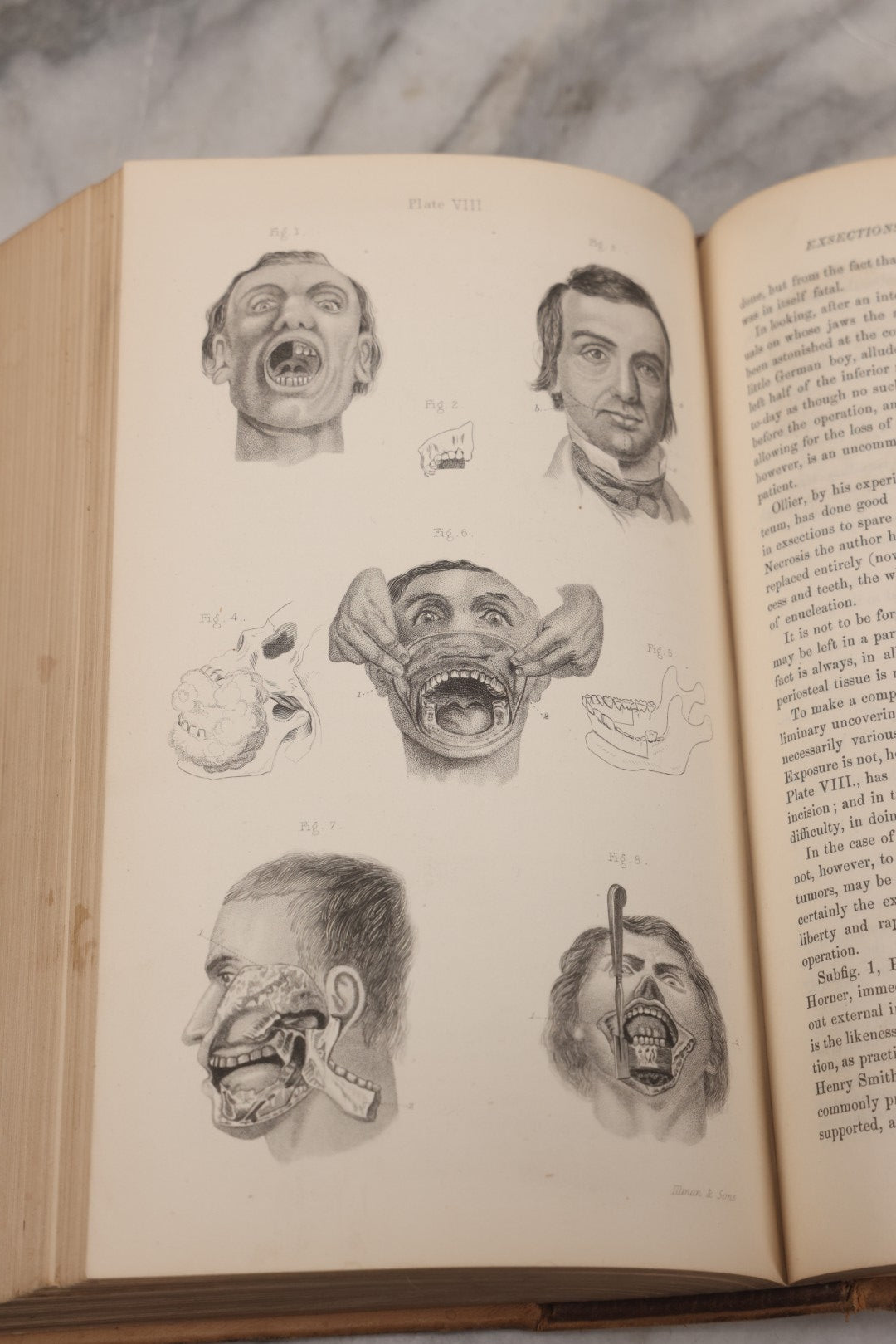 Lot 055 - "A System Of Oral Surgery: Diseases And Surgery Of The Mouth, Jaws, And Associated Parts" Antique Book By James E. Garretson, M.D., Illustrated With Steel Plates And Wood Cuts, 3rd Edition, Published By J.B. Lippincott & Co., Philadelphia, 1881