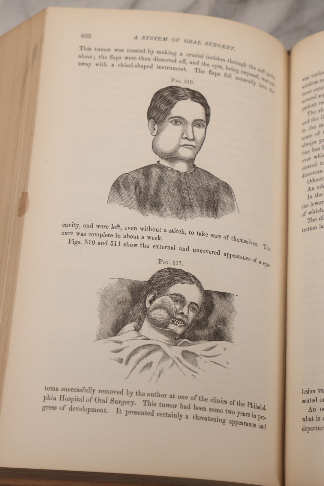 Lot 055 - "A System Of Oral Surgery: Diseases And Surgery Of The Mouth, Jaws, And Associated Parts" Antique Book By James E. Garretson, M.D., Illustrated With Steel Plates And Wood Cuts, 3rd Edition, Published By J.B. Lippincott & Co., Philadelphia, 1881