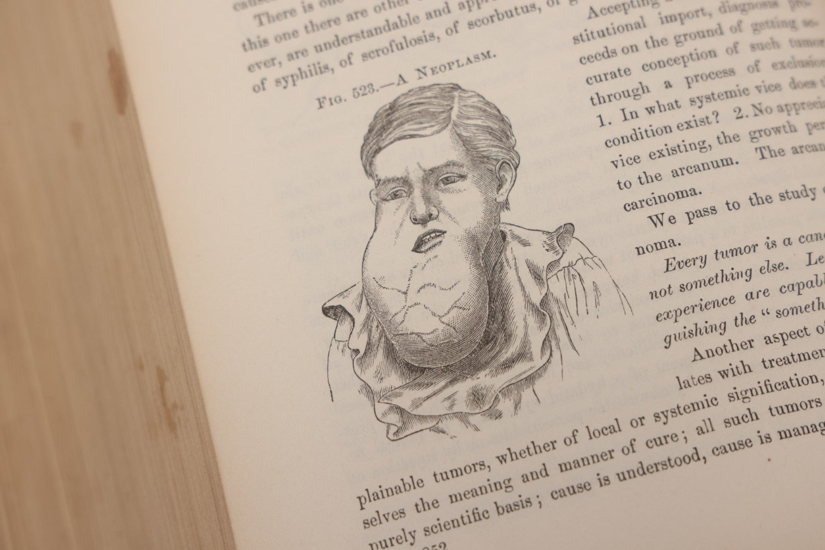 Lot 055 - "A System Of Oral Surgery: Diseases And Surgery Of The Mouth, Jaws, And Associated Parts" Antique Book By James E. Garretson, M.D., Illustrated With Steel Plates And Wood Cuts, 3rd Edition, Published By J.B. Lippincott & Co., Philadelphia, 1881