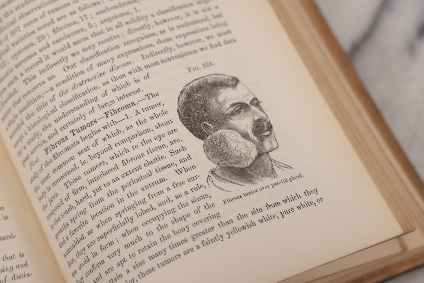 Lot 055 - "A System Of Oral Surgery: Diseases And Surgery Of The Mouth, Jaws, And Associated Parts" Antique Book By James E. Garretson, M.D., Illustrated With Steel Plates And Wood Cuts, 3rd Edition, Published By J.B. Lippincott & Co., Philadelphia, 1881