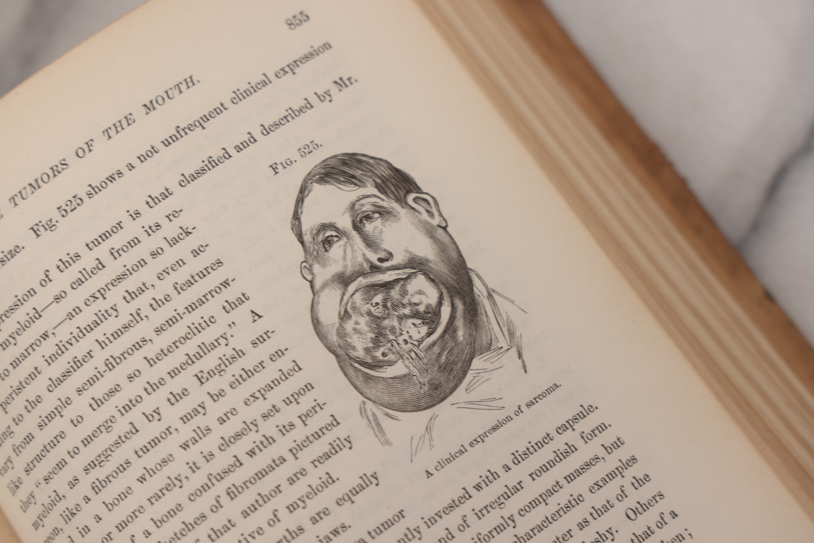 Lot 055 - "A System Of Oral Surgery: Diseases And Surgery Of The Mouth, Jaws, And Associated Parts" Antique Book By James E. Garretson, M.D., Illustrated With Steel Plates And Wood Cuts, 3rd Edition, Published By J.B. Lippincott & Co., Philadelphia, 1881