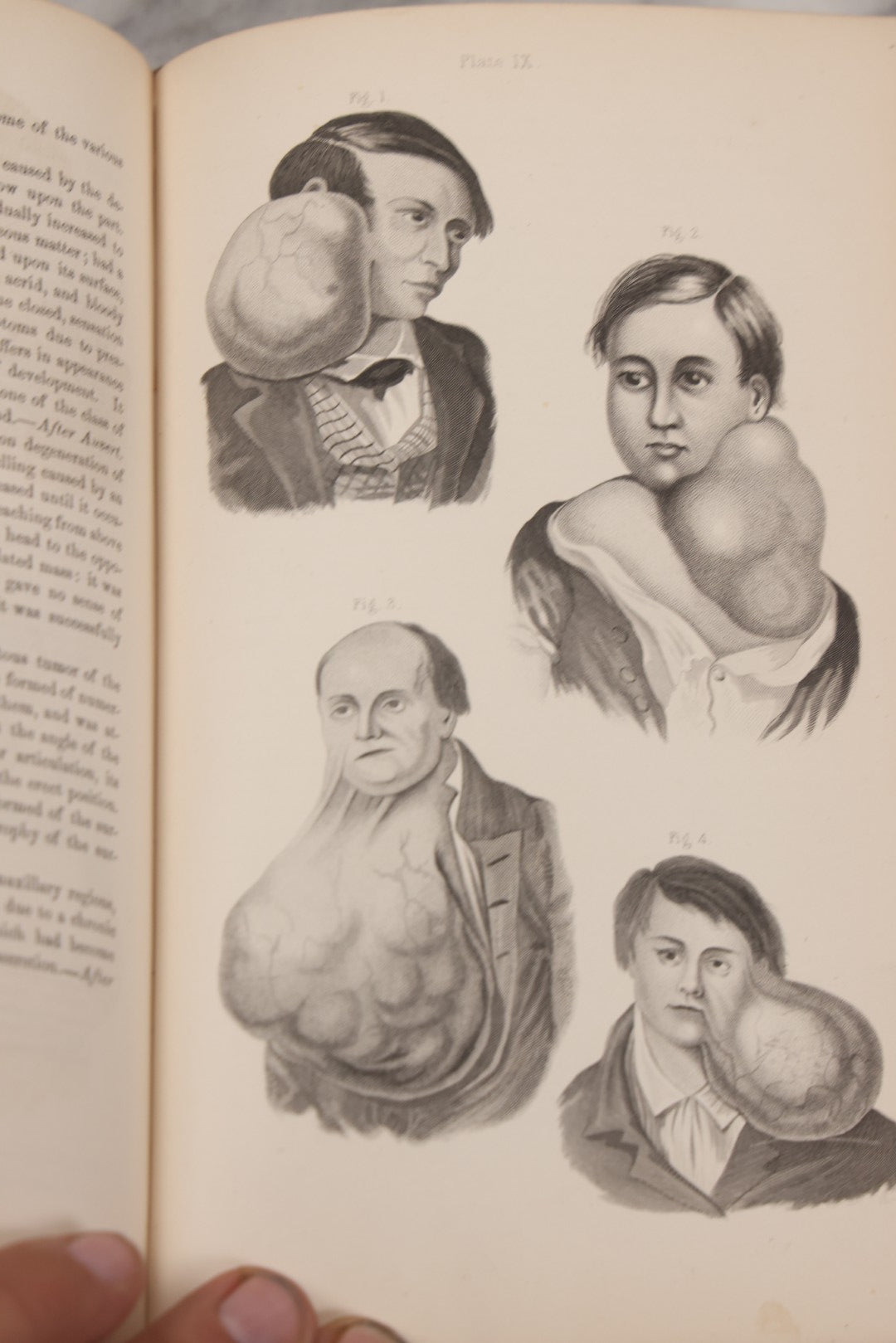 Lot 055 - "A System Of Oral Surgery: Diseases And Surgery Of The Mouth, Jaws, And Associated Parts" Antique Book By James E. Garretson, M.D., Illustrated With Steel Plates And Wood Cuts, 3rd Edition, Published By J.B. Lippincott & Co., Philadelphia, 1881