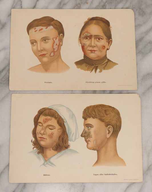 Lot 168 - Pair Of Antique Swedish Color Medical Bookplates By Centraltryckeriet, Stockholm, Depicting Facial Conditions Including Psoriasis, Disfigurement From Syphilis, Shingles, And Lupus Or Skin Tuberculosis