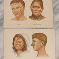 Lot 168 - Pair Of Antique Swedish Color Medical Bookplates By Centraltryckeriet, Stockholm, Depicting Facial Conditions Including Psoriasis, Disfigurement From Syphilis, Shingles, And Lupus Or Skin Tuberculosis