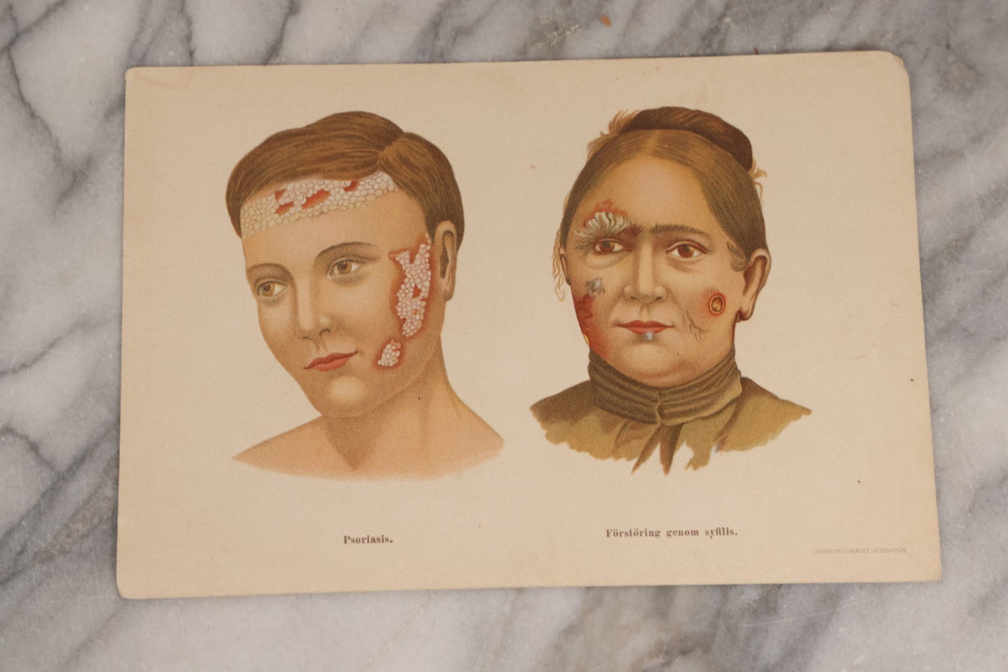 Lot 168 - Pair Of Antique Swedish Color Medical Bookplates By Centraltryckeriet, Stockholm, Depicting Facial Conditions Including Psoriasis, Disfigurement From Syphilis, Shingles, And Lupus Or Skin Tuberculosis