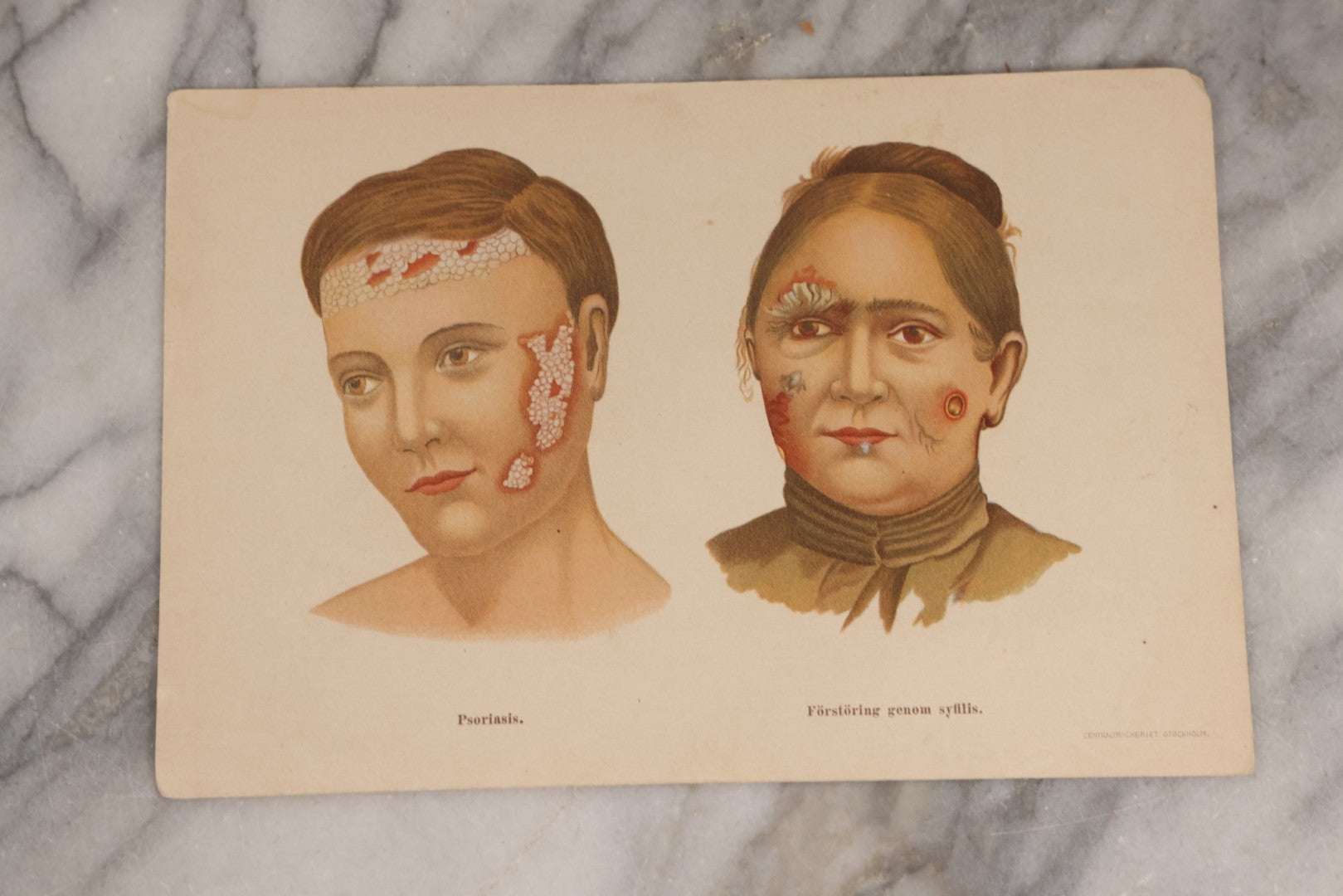 Lot 168 - Pair Of Antique Swedish Color Medical Bookplates By Centraltryckeriet, Stockholm, Depicting Facial Conditions Including Psoriasis, Disfigurement From Syphilis, Shingles, And Lupus Or Skin Tuberculosis