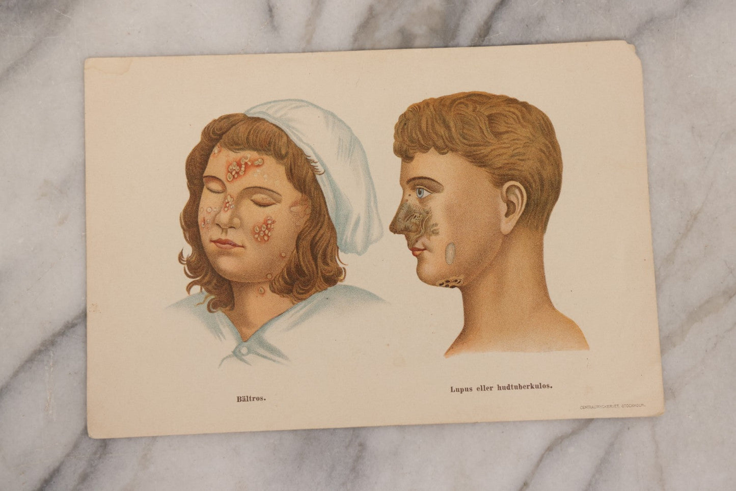 Lot 168 - Pair Of Antique Swedish Color Medical Bookplates By Centraltryckeriet, Stockholm, Depicting Facial Conditions Including Psoriasis, Disfigurement From Syphilis, Shingles, And Lupus Or Skin Tuberculosis