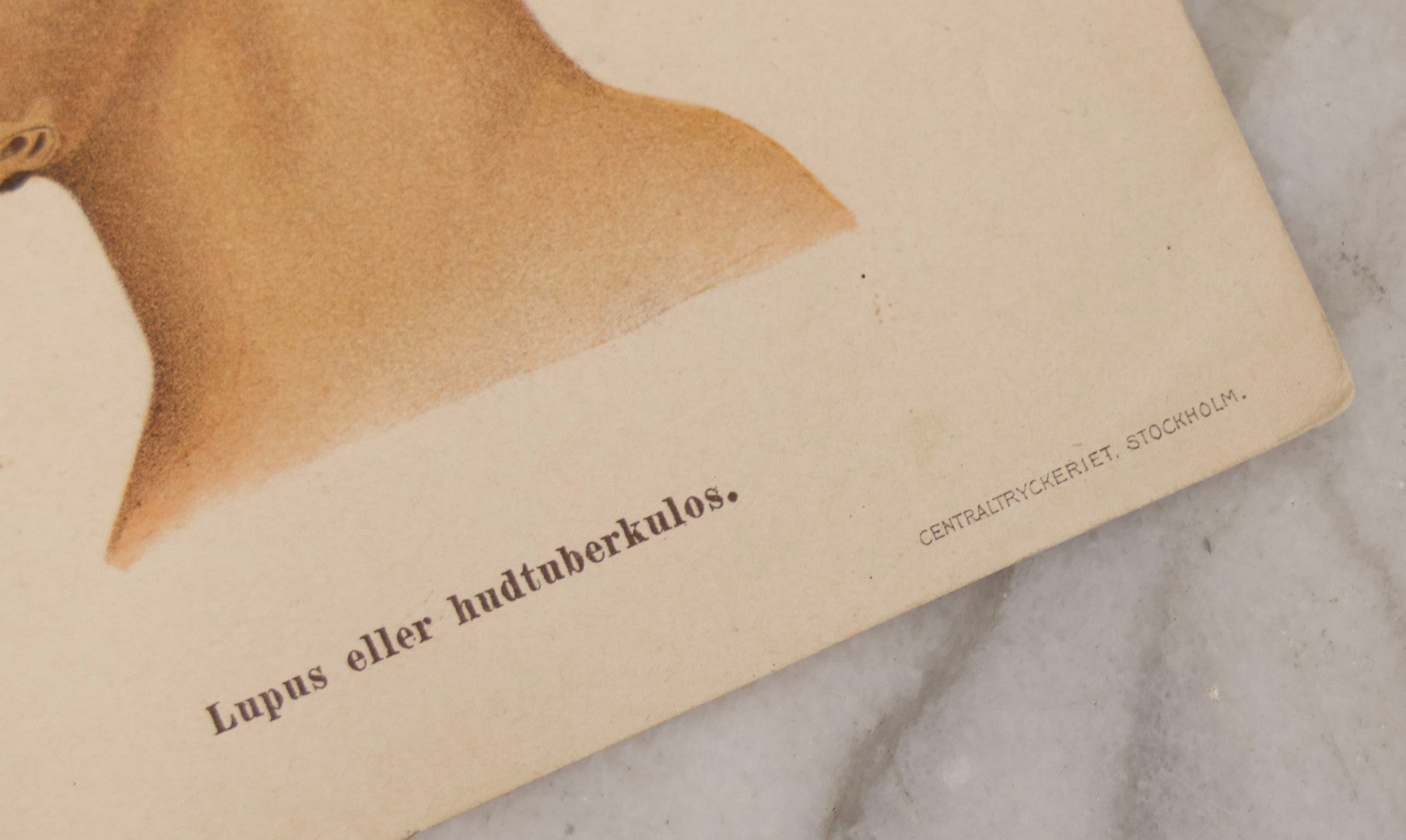 Lot 168 - Pair Of Antique Swedish Color Medical Bookplates By Centraltryckeriet, Stockholm, Depicting Facial Conditions Including Psoriasis, Disfigurement From Syphilis, Shingles, And Lupus Or Skin Tuberculosis