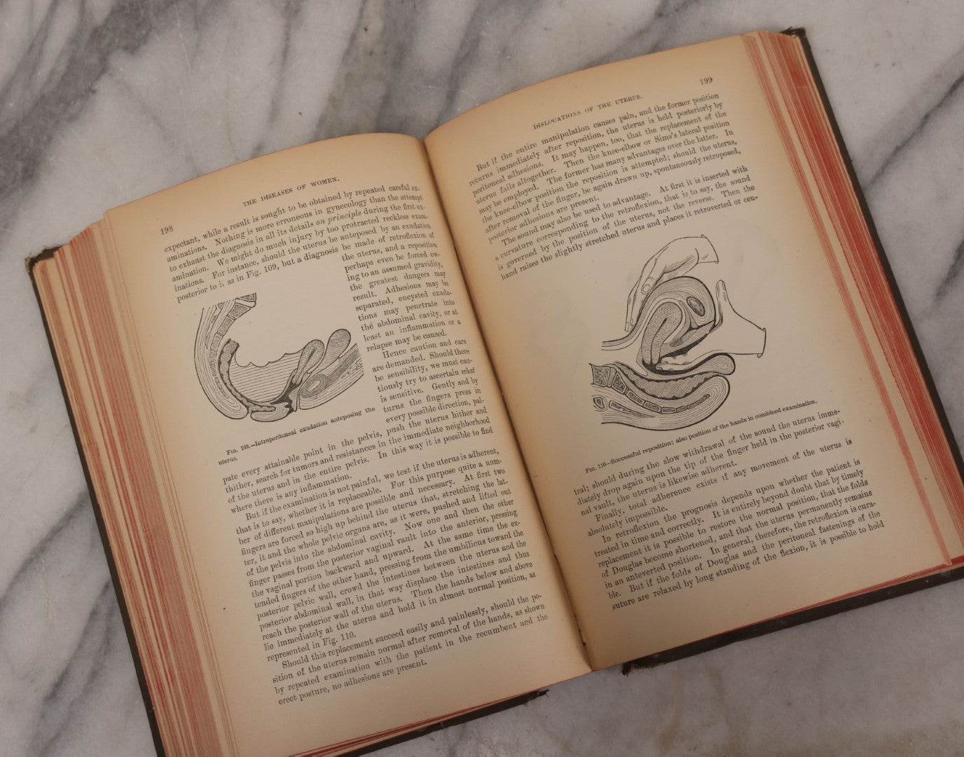 Lot 233 - "The Diseases Of Women" Antique Gynecology And Obstetrics Medical Book By Heinrich Fritsch, Translated By Isidor Furst, Published By William Wood & Company, New York, 1883, With 159 Wood Engravings