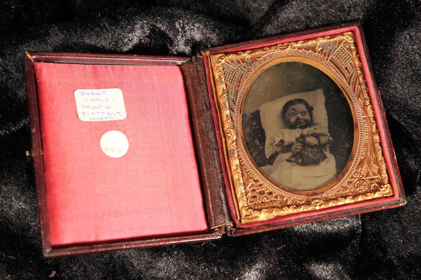 Post Mortem Ambrotype of a Baby with Burn Injuries in Full Union Case, Sixth-Plate